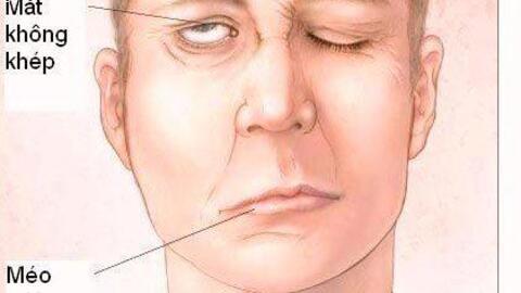 LIỆT DÂY THẦN KINH NGOẠI BIÊN SỐ 7 (NGUYÊN NHÂN- TRIỆU CHỨNG- CÁCH CHUẨN ĐOÁN VÀ ĐIỀU TRỊ)