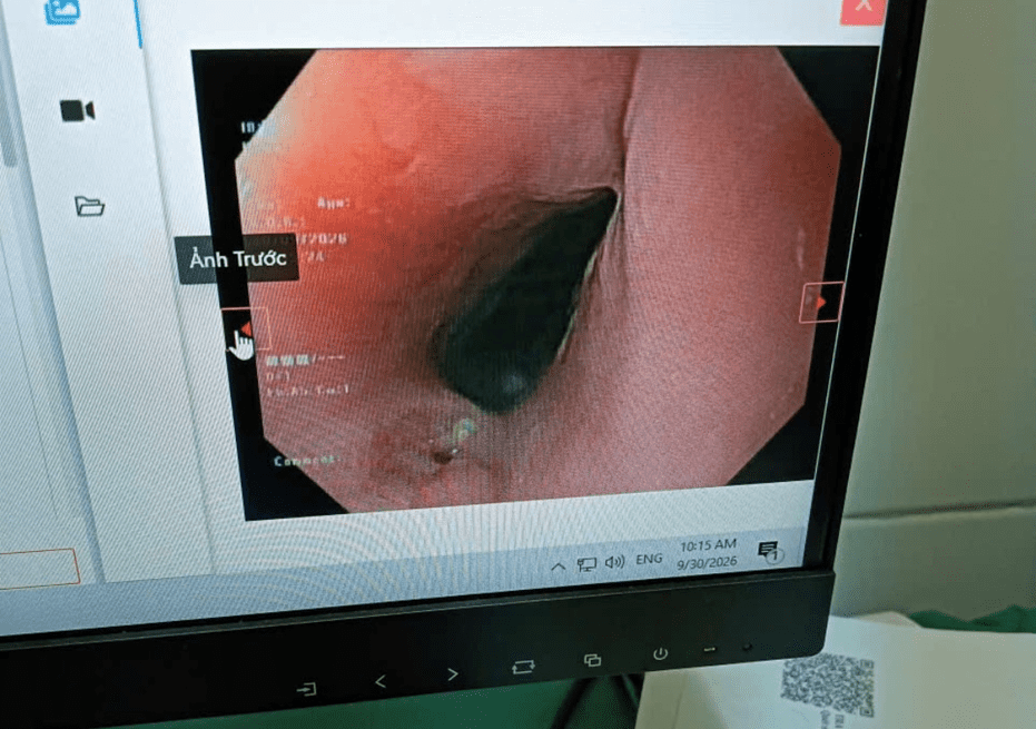 Hình ảnh nội soi sau khi xử trí dị vật.